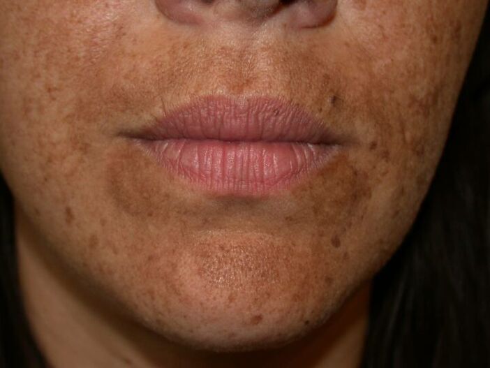 Las manchas pigmentadas en la cara son una indicación para un procedimiento con láser. 
