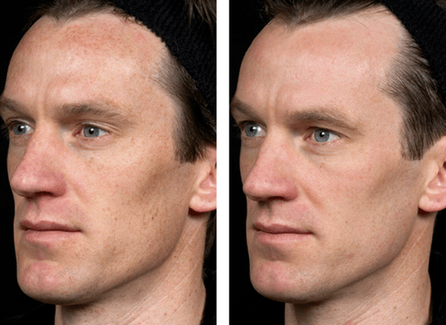 antes y después del rejuvenecimiento cutáneo fraccional foto 5