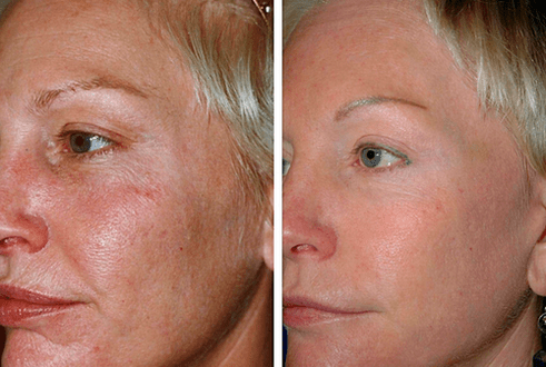 antes y después del rejuvenecimiento fraccional de la piel foto 1