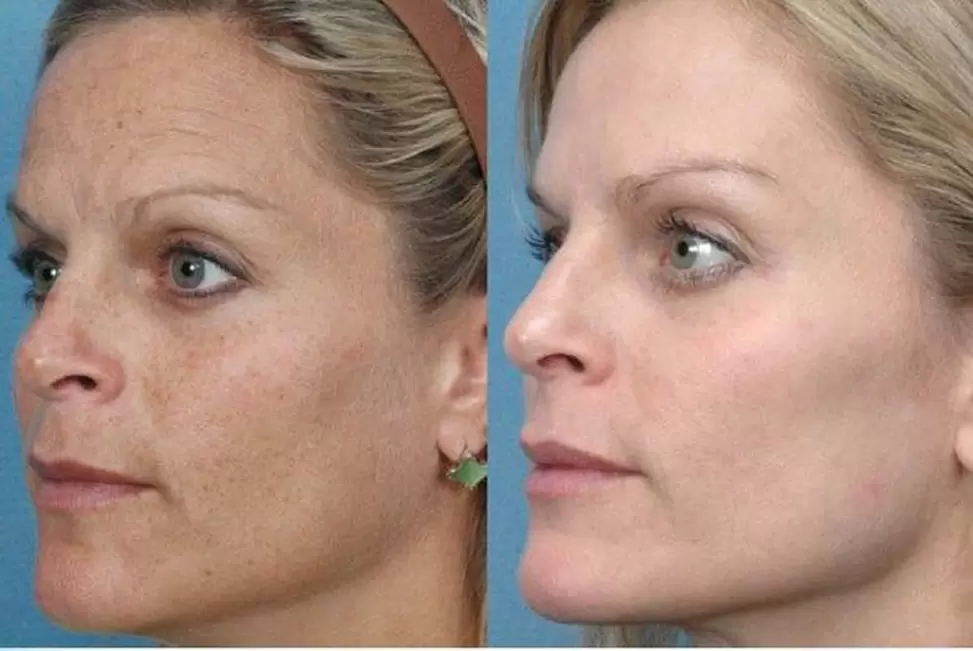 antes y después del rejuvenecimiento de la piel con hardware foto 1