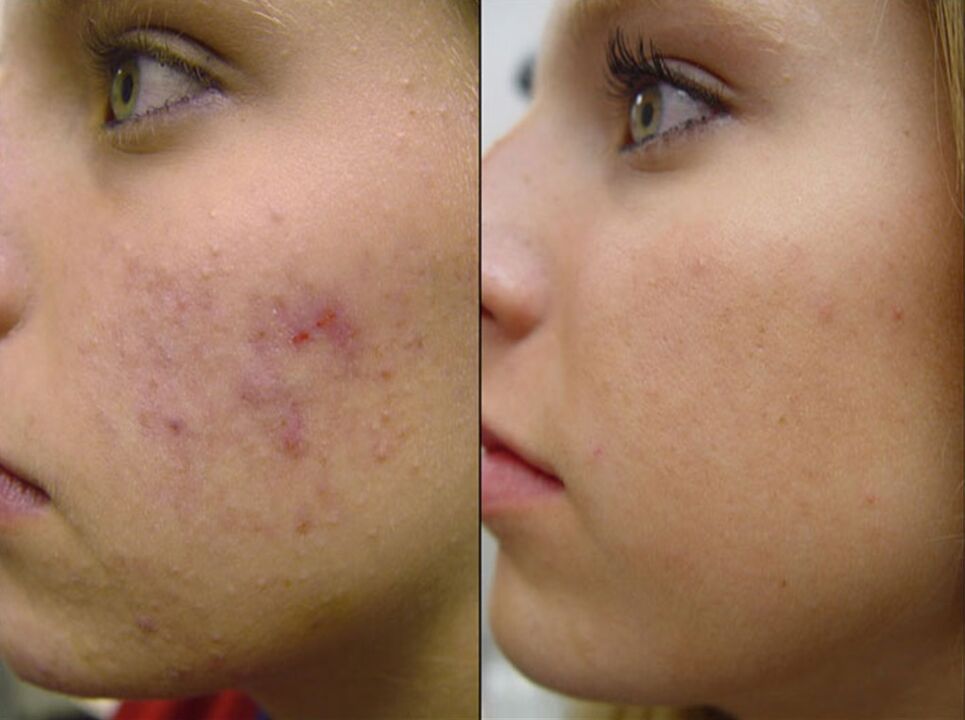 antes y después del rejuvenecimiento de la piel con hardware foto 2