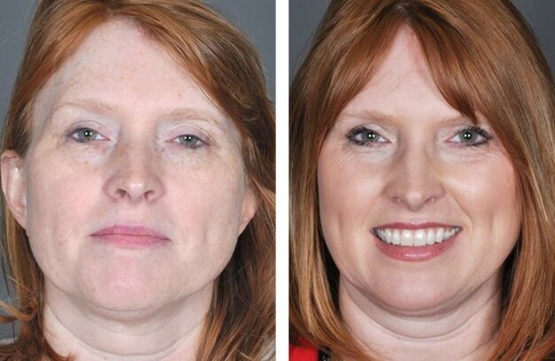 Procedimiento de rejuvenecimiento facial antes y después de una serie de procedimientos