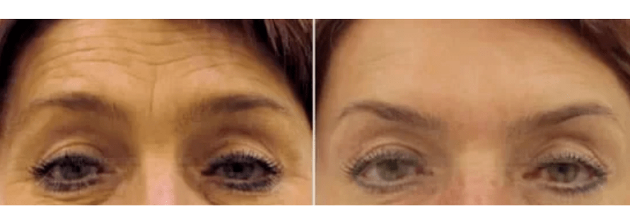 dispositivos para rejuvenecimiento fraccional