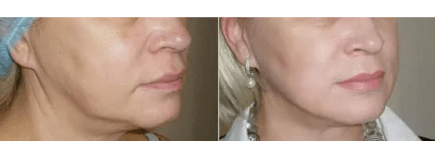 recuperación después del rejuvenecimiento de la piel