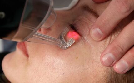 procedimiento de rejuvenecimiento de la piel facial con láser